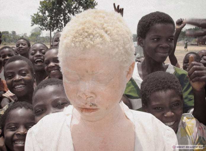Девочка альбинос среди сверстников