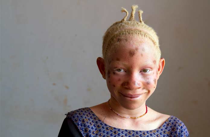 Африканская девочка-альбинос
